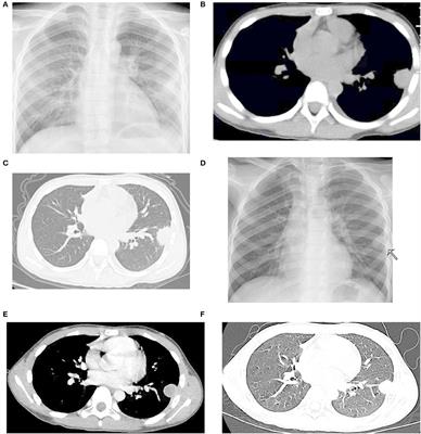 An isolated pulmonary nodule secondary to Streptococcus intermedius infection in an otherwise healthy 10-year-old boy: A case report and literature review